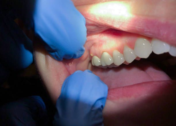 Best Broken or Chipped Tooth Repair in Wheatland, WY